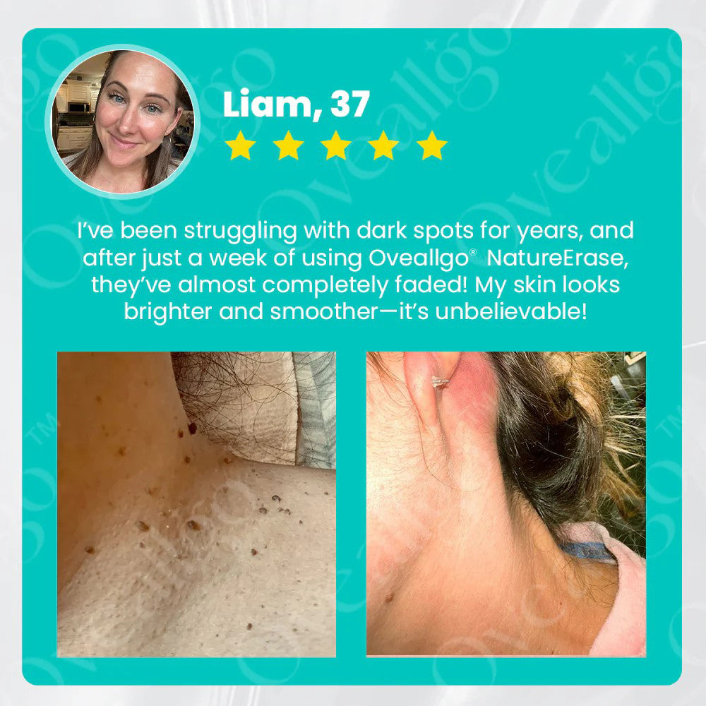 NatureErase | Gel per Macchie, Nei e Verruche