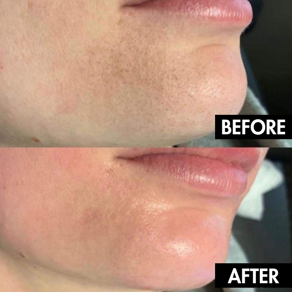 PurePore™ | Aspirateur électrique de porifères pour le visage