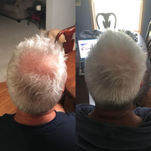 Purc™ | Olio Naturale per Prevenire la Caduta dei Capelli