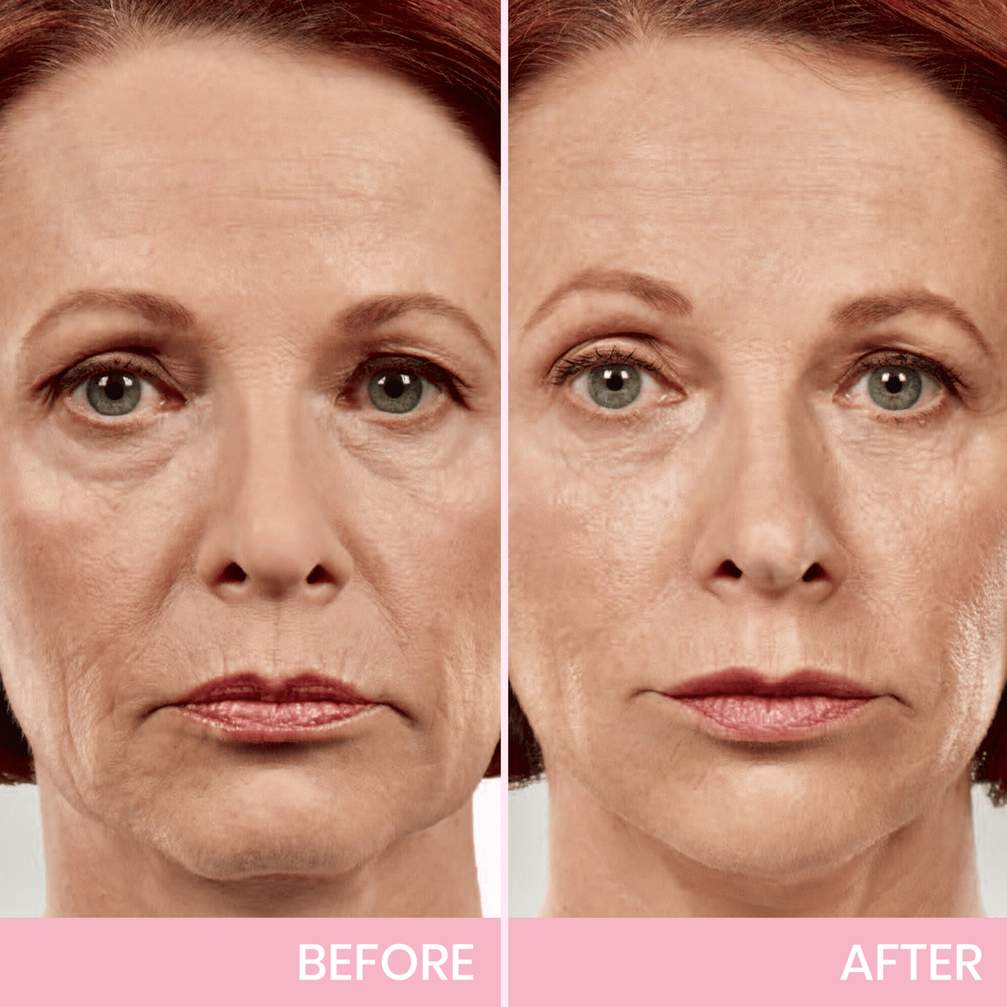 InvisiLift™ | Nastro Adesivo Invisibile per Lifting del Viso