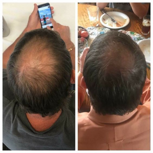 Purc™ | Olio Naturale per Prevenire la Caduta dei Capelli